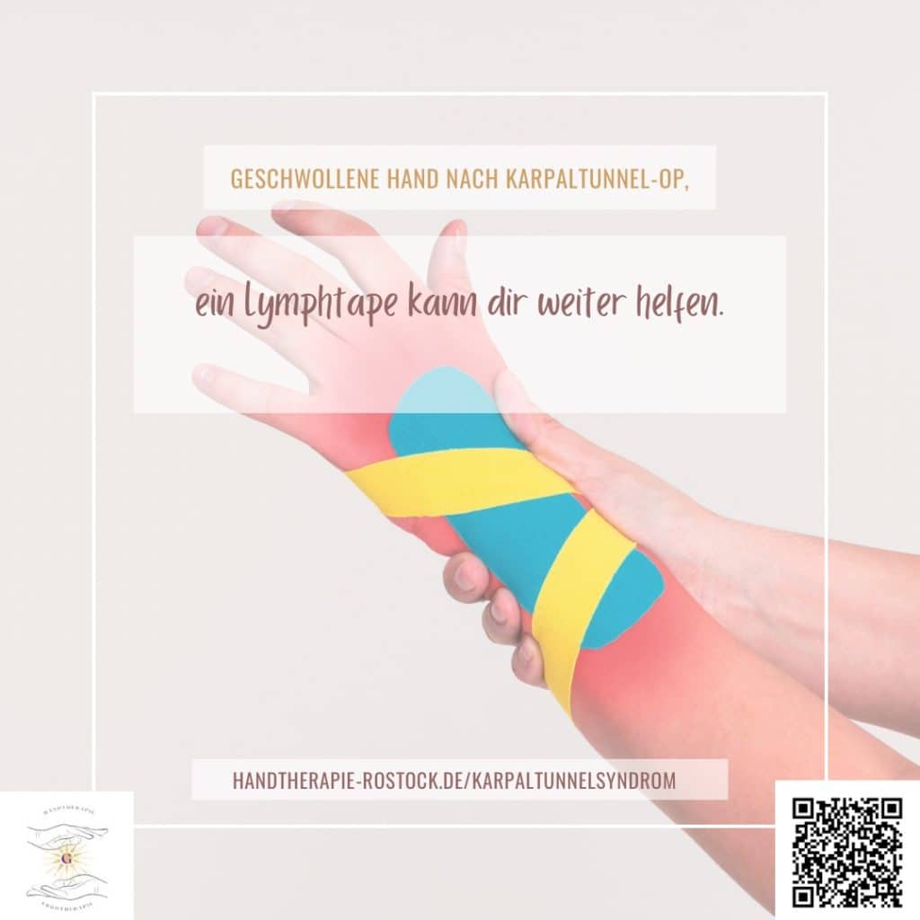 geschwollene hand nach karpaltunnel op