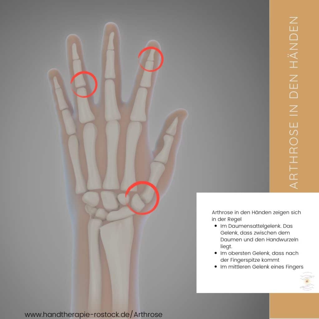Arthrose Hand